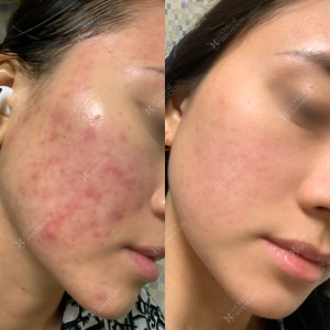 CẢI THIỆN SẮC TỐ SAU VIÊM