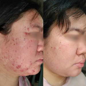ĐIỀU TRỊ MỤN NỘI TIẾT