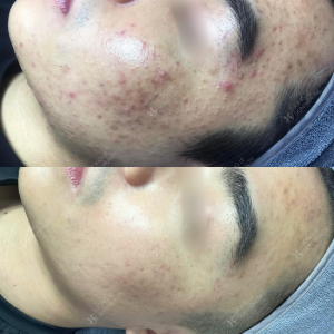 GIẢM MỤN ẨN, DA CĂNG BÓNG