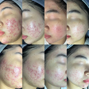 GIẢM MỤN ẨN, MỤN VIÊM,CẢI THIỆN SẸO RỖ