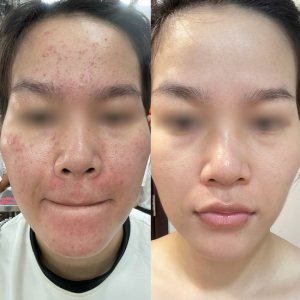 GIẢI QUYẾT MỤN, DA CĂNG BÓNG