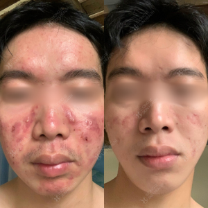 ĐIỀU TRỊ MỤN VIÊM
