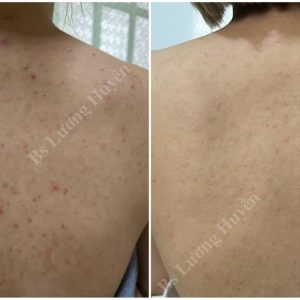 GIẢM MỤN LƯNG